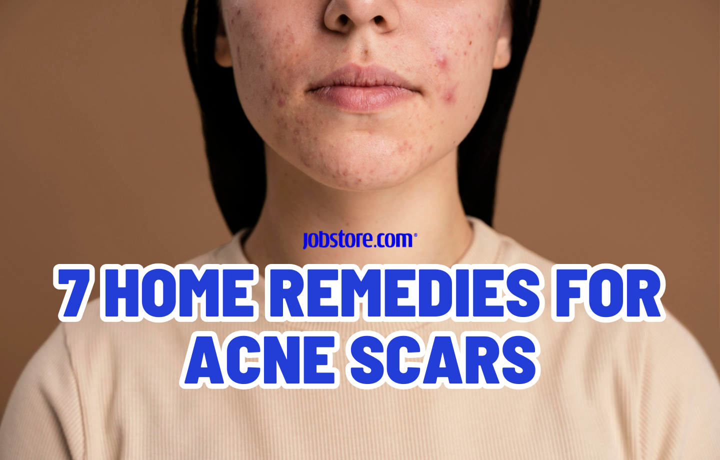 7 Home Remedies For Acne scars