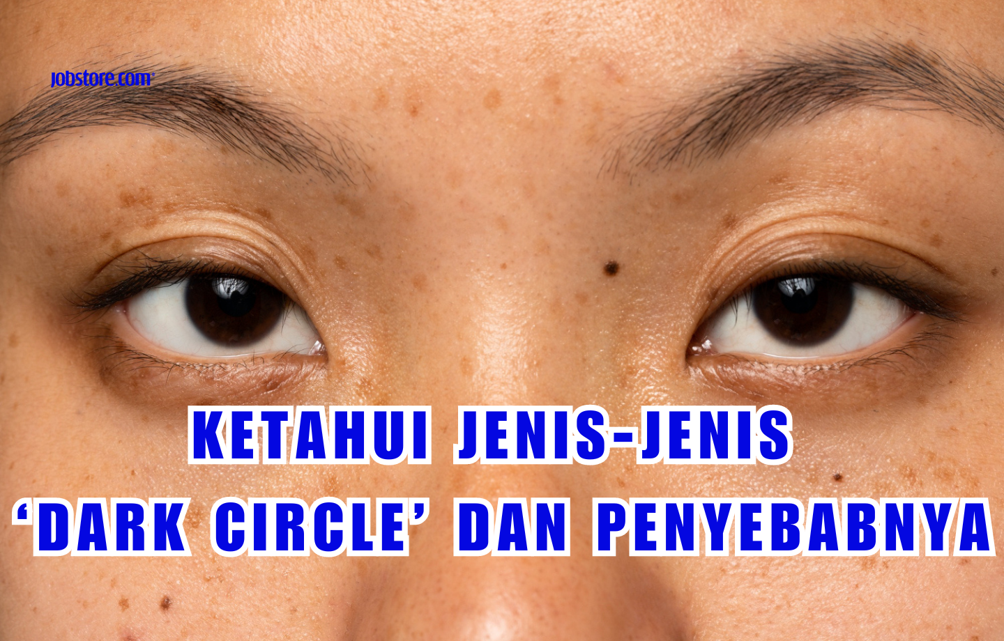 Ketahui Jenis-Jenis ‘Dark Circle’ Dan Penyebabnya