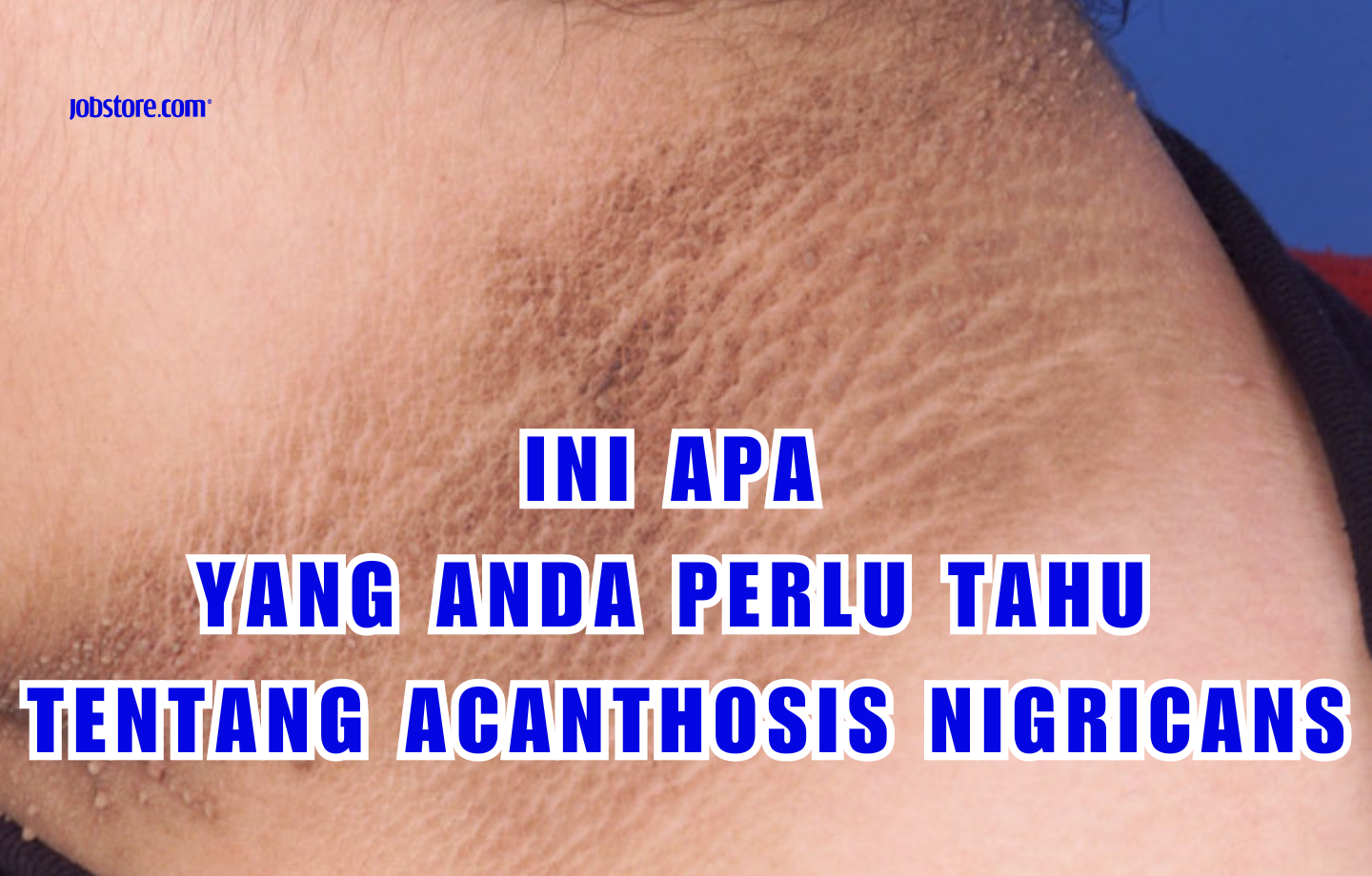 Ini Apa Yang Anda Perlu Tahu Tentang Acanthosis Nigricans
