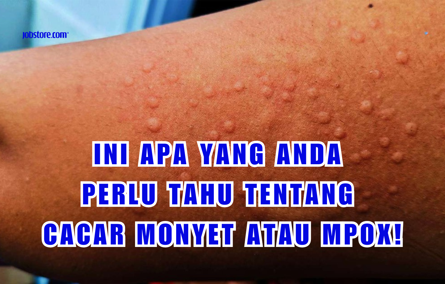 Ini Apa Yang Anda Perlu Tahu Tentang Cacar Monyet Atau MPox!